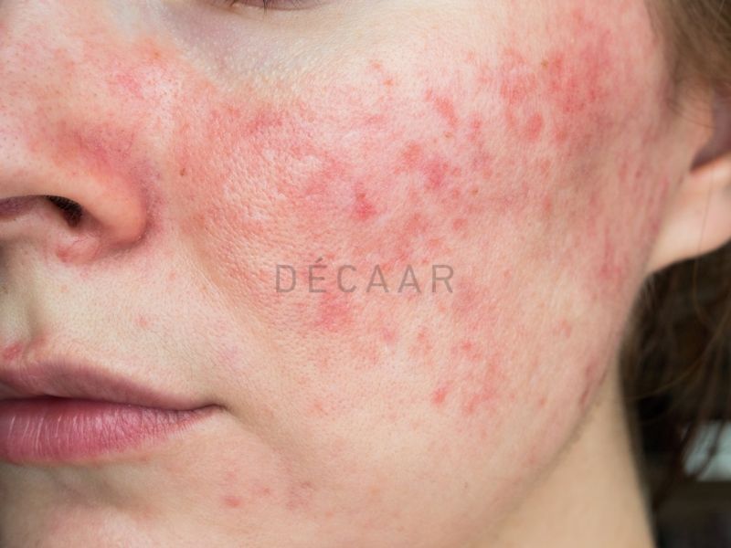 phục hồi da sau tái tạo